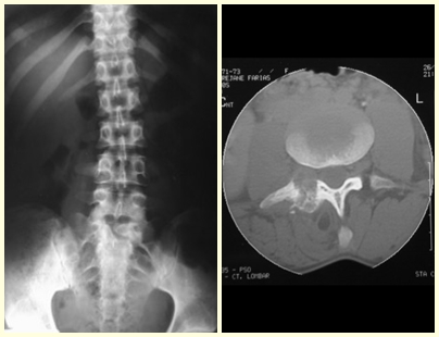 Figura 5 – escoliose antálgica devido à osteoblastoma. Fig. 6 – fratura do pedículo pelo tumor ósseo.