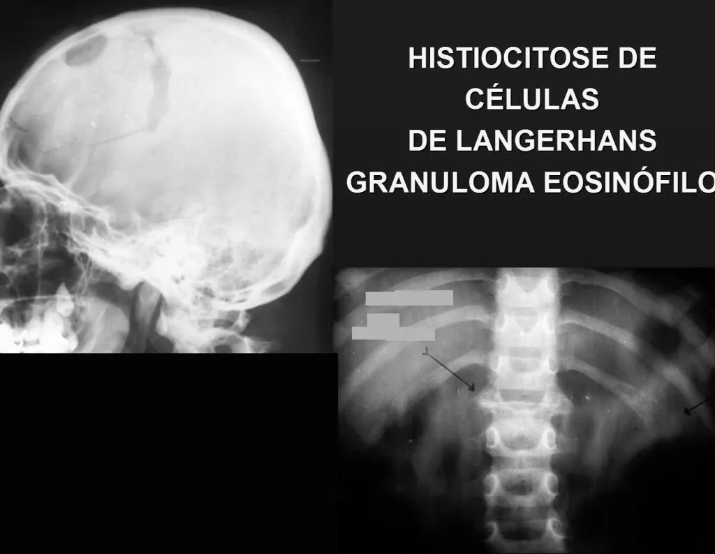 Figura 7 lesão osteolítica na calota craniana, freqüente localização e achatamento do corpo vertebral (vértebra plana de Calvé.