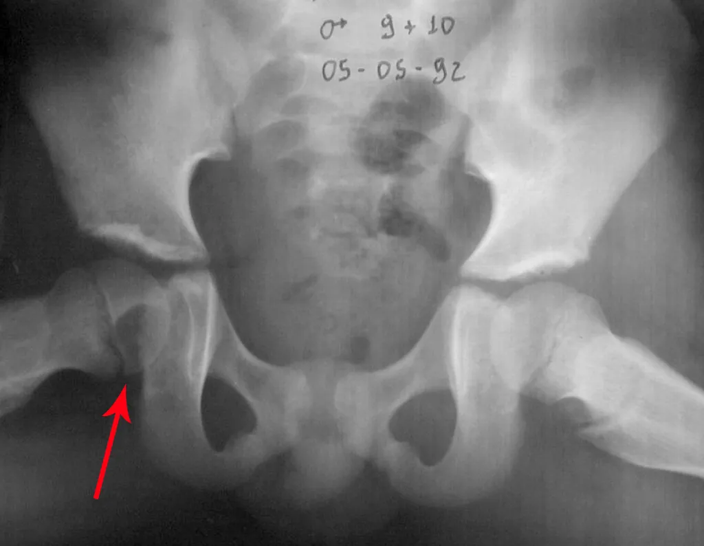 Fig. 6 – Lesão lítica posterior e medial na cabeça femoral direita.