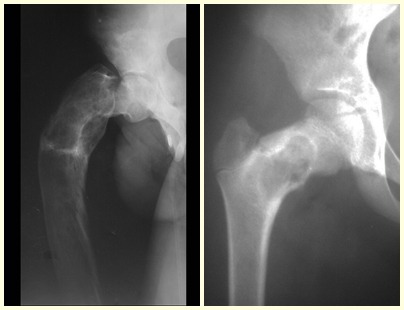 Figura 41 – Deformidade em cajado de pastor, seguida de fratura. Fig. 42 – fratura do colo femoral, em displasia fibrosa, sem deformidade prévia.