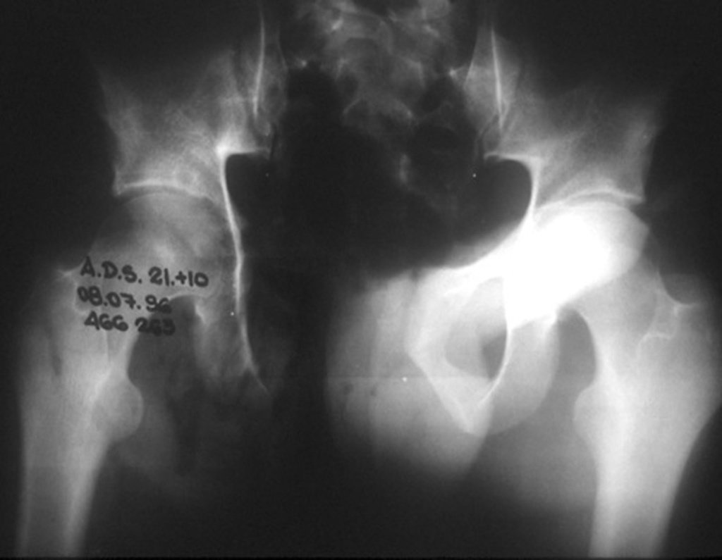 Figura 5: Corte da peça ressecada, evidenciando as margens e o tecido neoplásico irregular, de aspecto cartilaginoso, com áreas de calcificação e necrose tumoral. Figura 6: Radiografia após ressecção, com função normal do quadril.