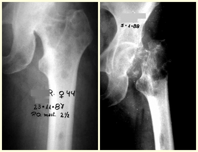 Figura 17: Lesões líticas em novembro de 1987. Figura 18: Destruição e fratura proximal do fêmur.