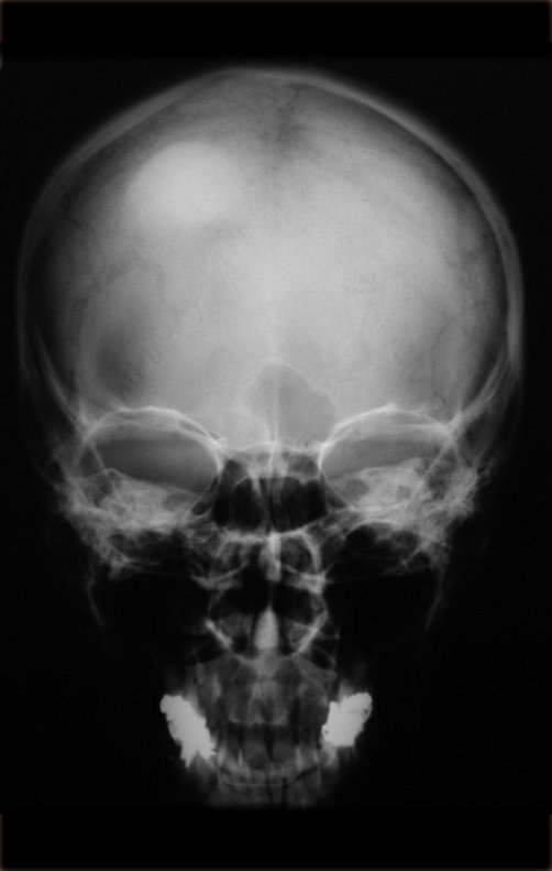 Figura 1: Radiografia do crânio com lesão nodular, densa, homogênea, na calota.