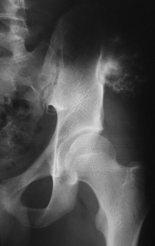 Figura 63: Queixa de dor e aumento da lesão na radiografia.