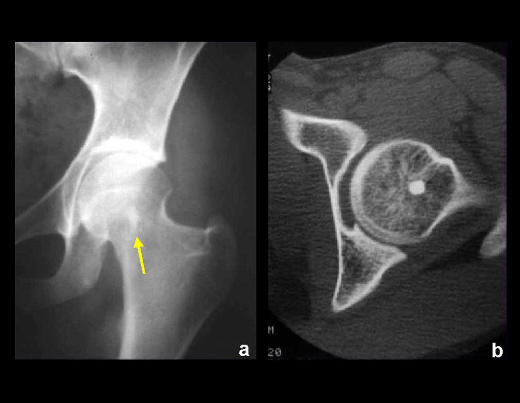 Figura 13 : Osteoma medular do colo femoral, enostose óssea.