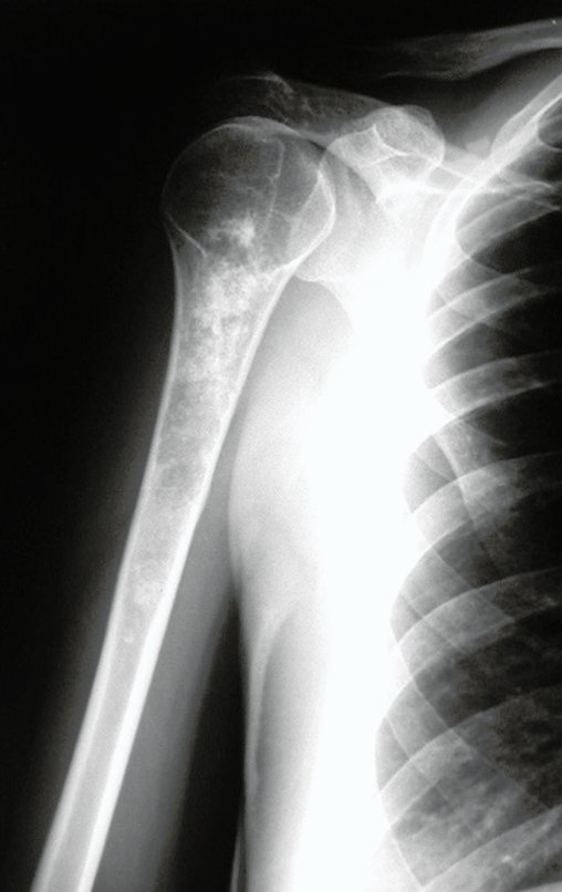 Figura 11: Tumor central, com focos de calcificação, erosão da cortical e alargamento do canal medular.