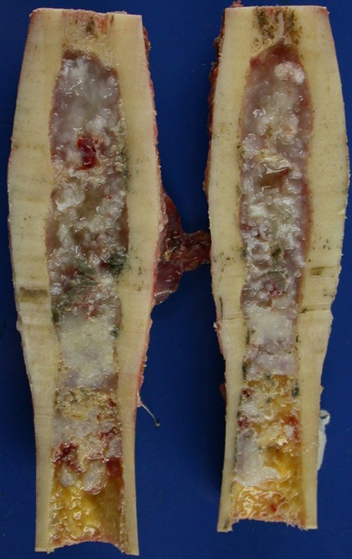 Figura 50: aspecto macroscópico do corte da peça. Verificamos focos de calcificação, espessamento e erosão em saca bocado da cortical interna.