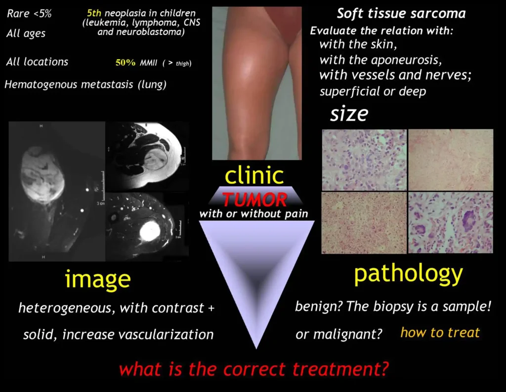 Quadro 2: Os tumores de tecidos moles são raros, representam 5 % das neoplasias, ocorrendo em todas as idades e localizações, sendo 50 % nos membros inferiores. Representam a quinta neoplasia maligna na infância e sua disseminação é hematogênica. A biópsia é apenas uma amostra da lesão!