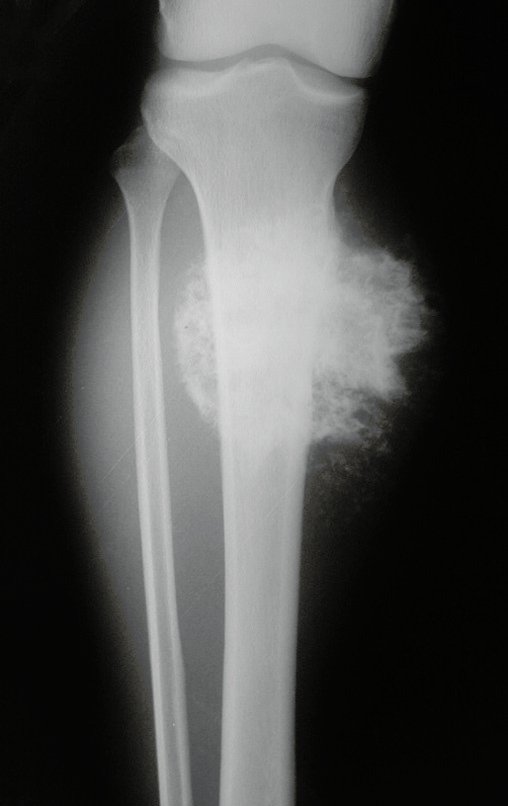 Figura 87: Lesão na região metadiafisária proximal da tíbia, condensante, com bordas irregulares e focos de calcificação com aspecto algodonoso.