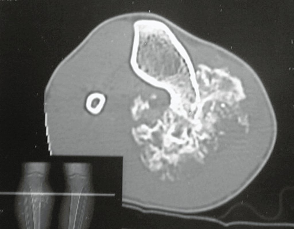 Figura 90: Tomografia caracterizando o osteocondroma pré-existente e a lesão irregular da degeneração sarcomatosa.