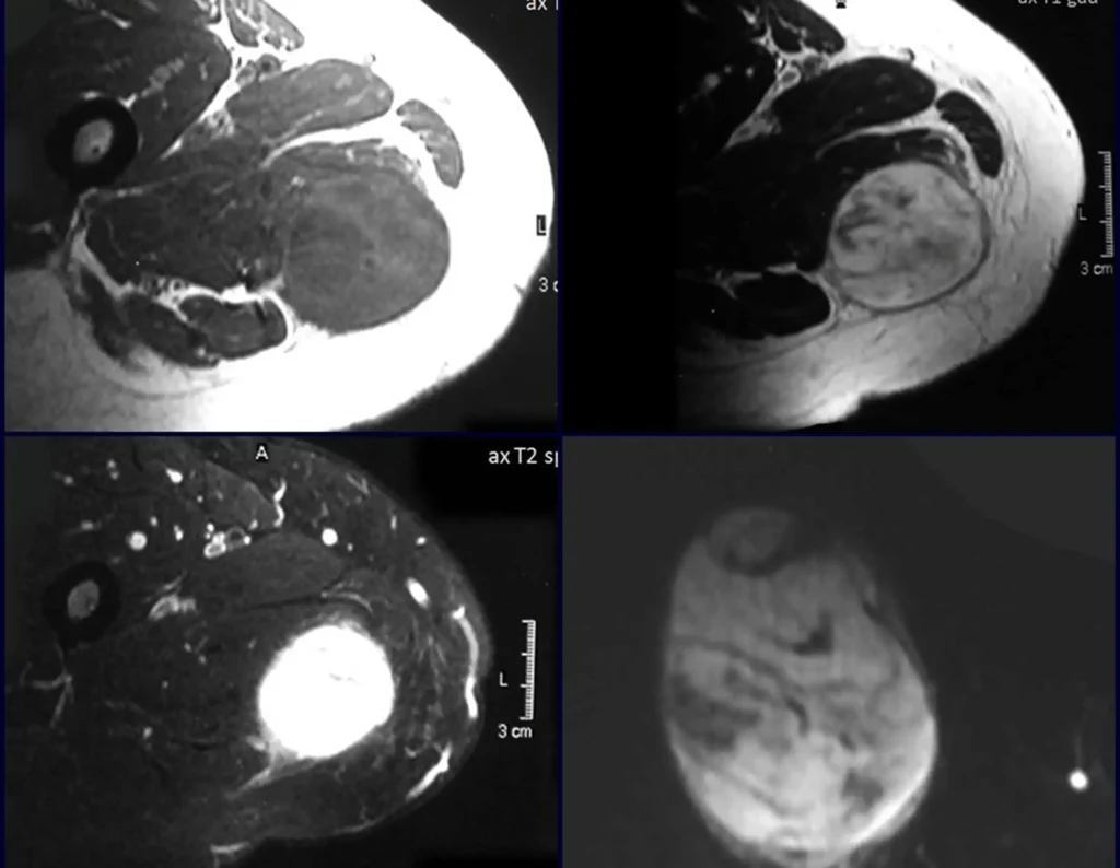 Figura 12: a- Rm axial T1, com lesão de baixo sinal, heterogênea, junto ao plano da musculatura adutora da coxa. b- Rm axial, captação de contraste, heterogênea, vascularizada e com aparente delimitação por pseudocapsula. c- RM axial T1 com saturação de gordura, evidencia o vaso nutrício da lesão. d- Rm sagital com captação de contraste e evidente vascularização.