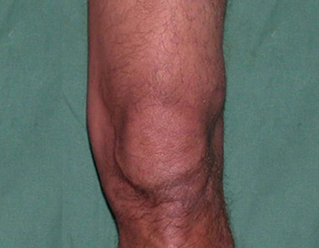 Figura 24: Condrossarcoma de tecidos moles na face lateral da coxa esquerda, próximo à patela (abaulamento lateral).