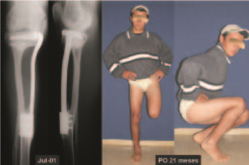 Fig. 12 – W.R.C., 16 anos. Pós-operatório 21 meses. Radiografia mostrando o fechamento da linha epifisária. Patiente com carga total e flexão do joelho.