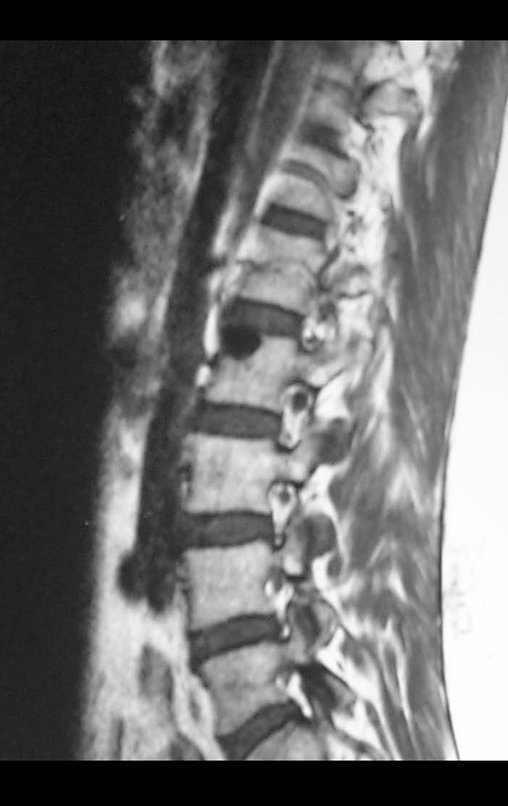 Figura 15: Rm sagital de osteoma medular do corpo vertebral.