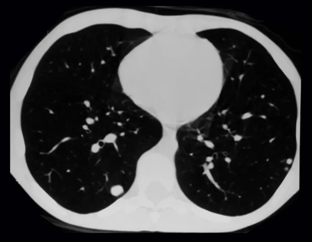 Metástases Pulmonares assintomáticas.