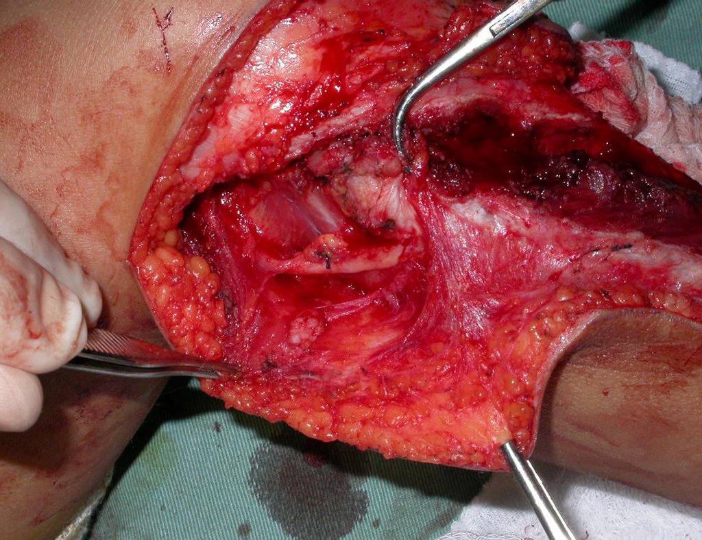 Figura 2b: abertura do perimisio e lateralização do músculo tibial anterior.