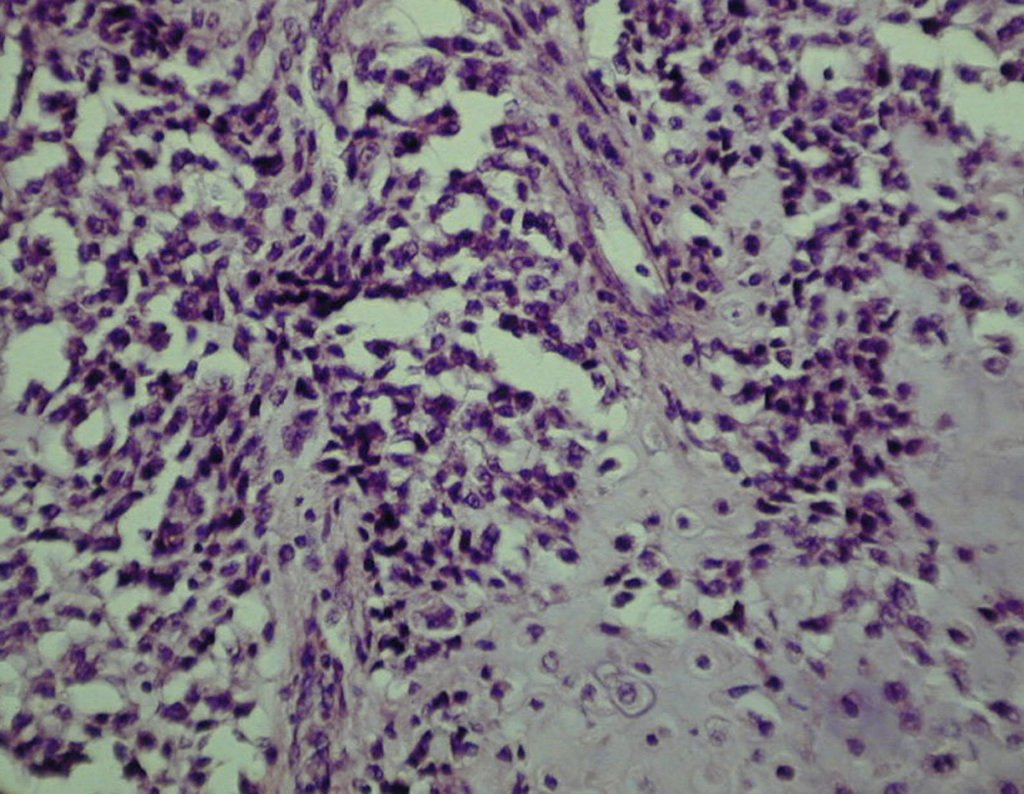 Figura 104: Histologia de condrossarcoma mesenquimal. Áreas de cartilagem diferenciada, entremeada por células redondas e fusiformes, com vasos de padrão hemangioperiocítico, encontrado no tecido mesenquimatoso.