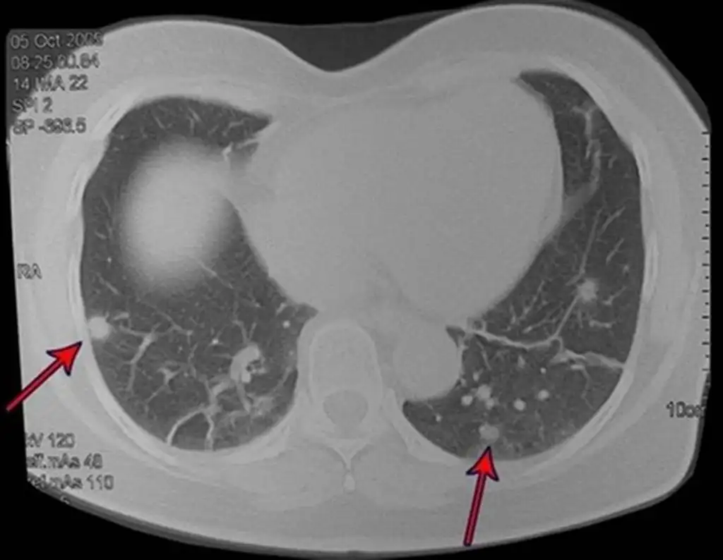 Figura 20: Tomografia de tórax, com inúmeras metástases, em ambos os pulmões, em 2011, quatorze anos após a primeira cirurgia, sendo doze deles em boa saúde e sem desconfortos.