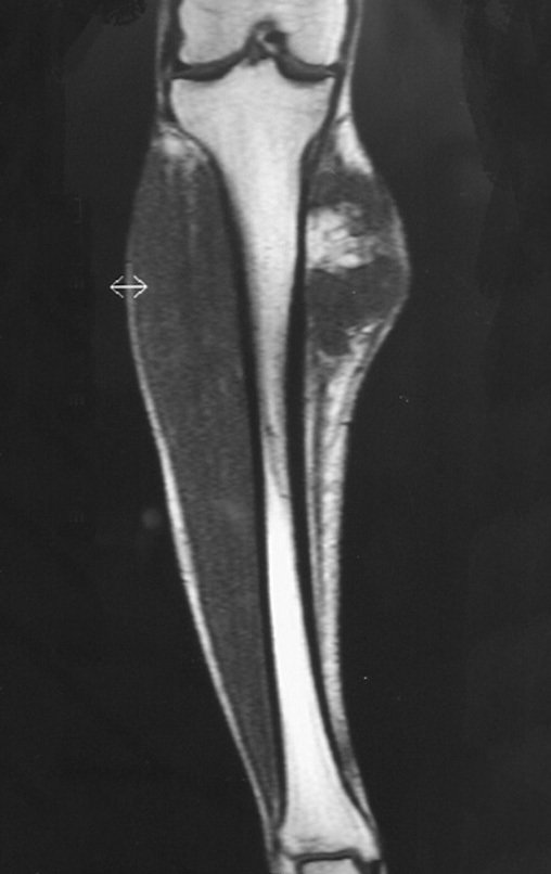 Figura 94: RM coronal T1 mostrando lesão heterogênea, exofítica, com bordas irregulares. A biópsia pode mostrar apenas áreas de osteocondroma.