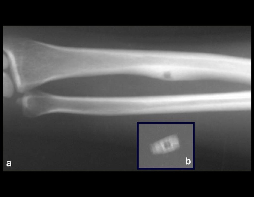 Figura 4: Radiografia do antebraço mostrando lesão subperiosteal na face ulnar do rádio, com nicho central do osteoma osteóide e halo de esclerose óssea (a), e tumor ressecado (b).