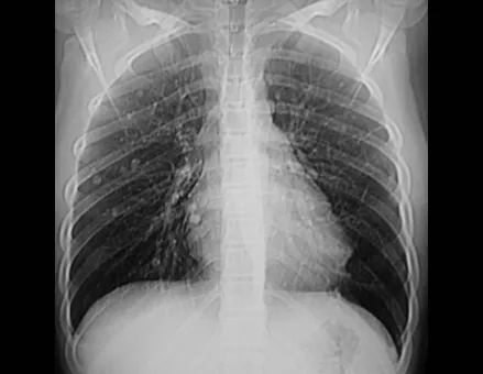 Fig. 12 – radiografia do tórax, com múltiplos nódulos.