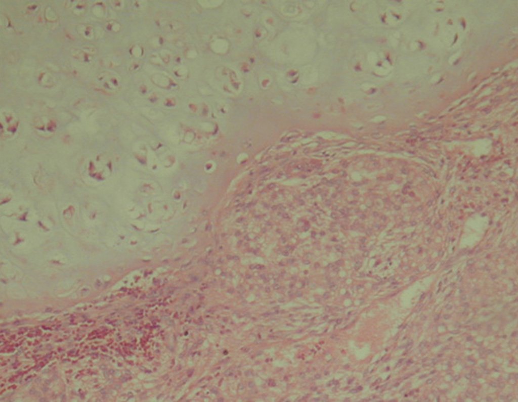 Figura 106: Histologia de condrossarcoma desdiferenciado. Áreas nítidas de cartilagem madura, com áreas de imaturidade, caracterizada por celularidade alta e mitoses atípicas.