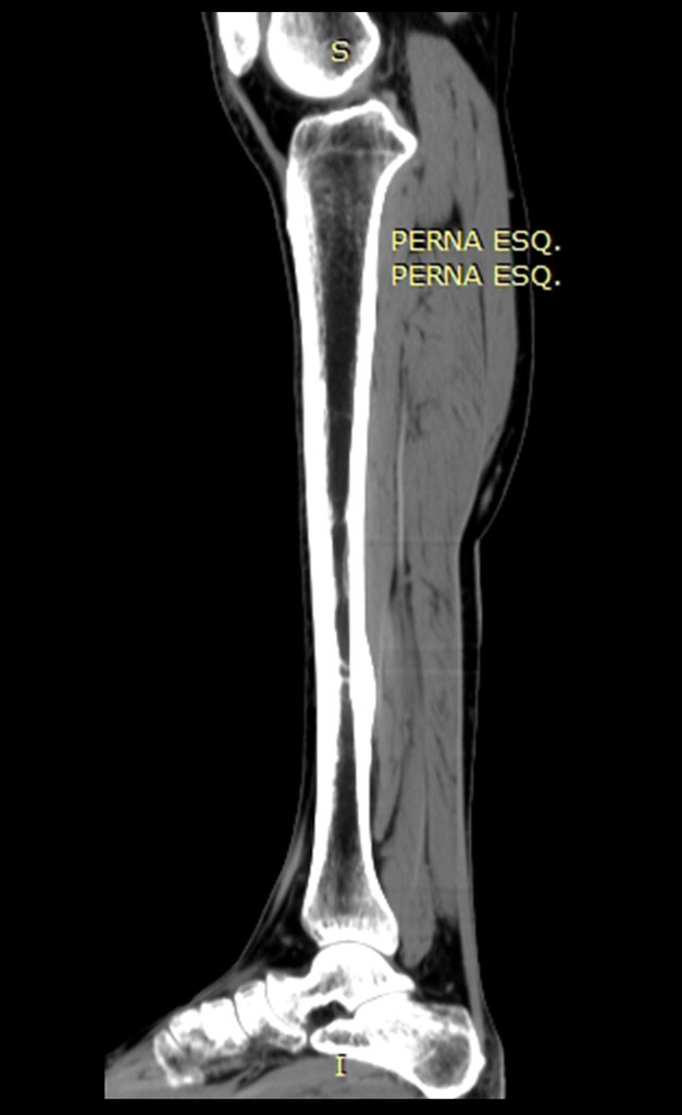 figura 6: TC sagital, densidade para tecidos moles, com esclerose na cortical posterior da tíbia.