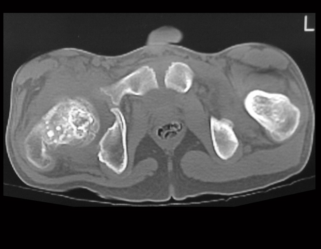 Figura 16: Tomografia do quadril em 05/08/1999.