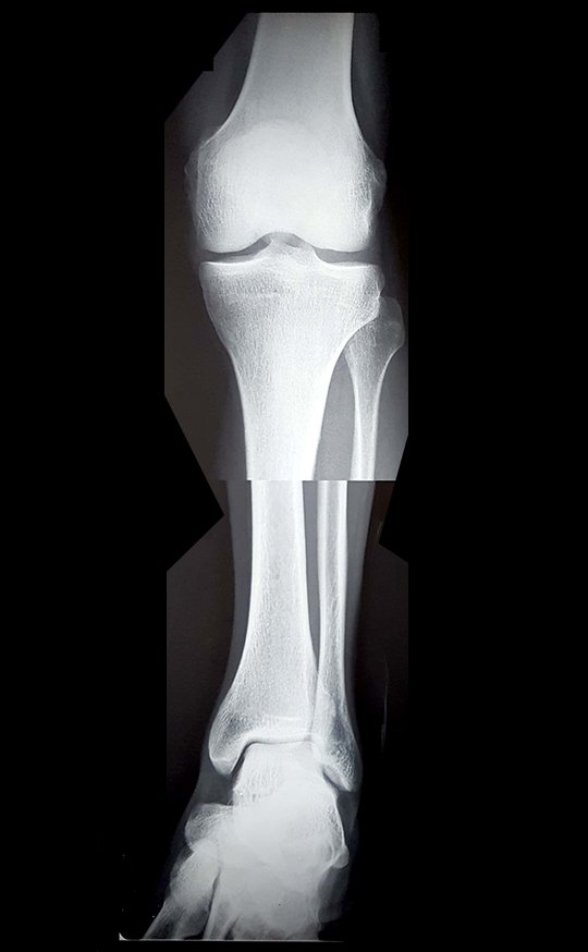 Figura 02: Radiografia do joelho e tornozelo esquerdos, frente.