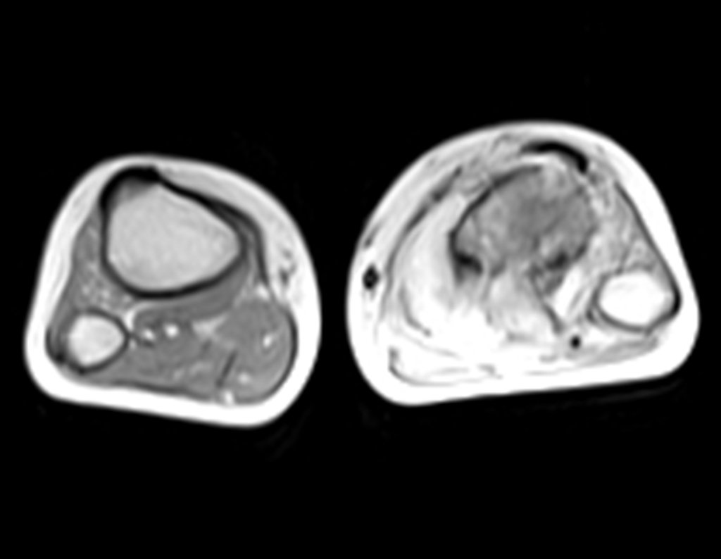 Figura 25: RM axial T1 tse-fil-gad.