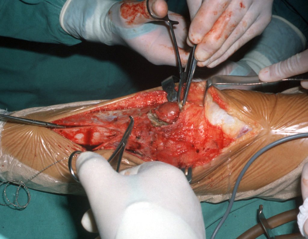 Figura 4: Acesso para patelar medial, deixando as incisões anteriores. Dissecção contornando o nódulo do sub cutâneo.