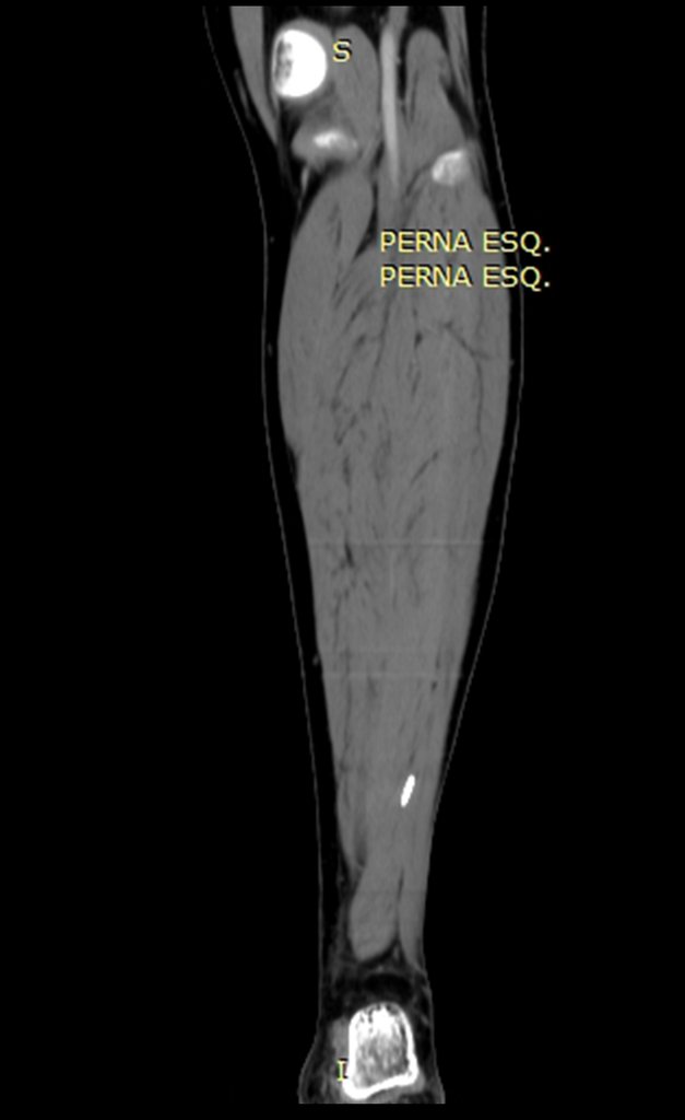 Figura 24: Tomografia coronal com janela para tecidos moles evidenciando a mesma imagem.