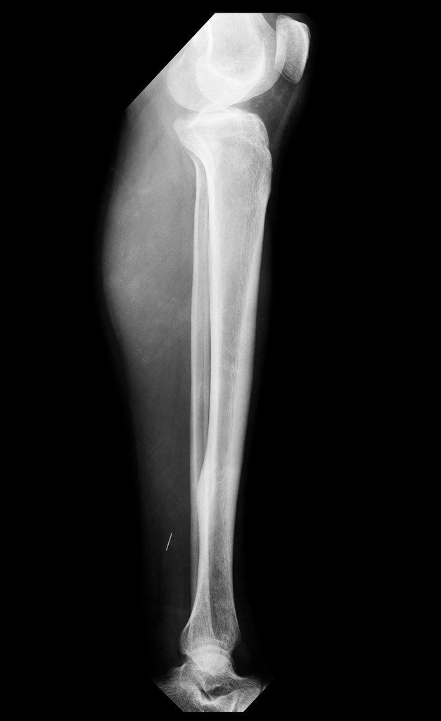 Figura 2: Radiografia,perfil, com esclerose na cortical póstero medial.