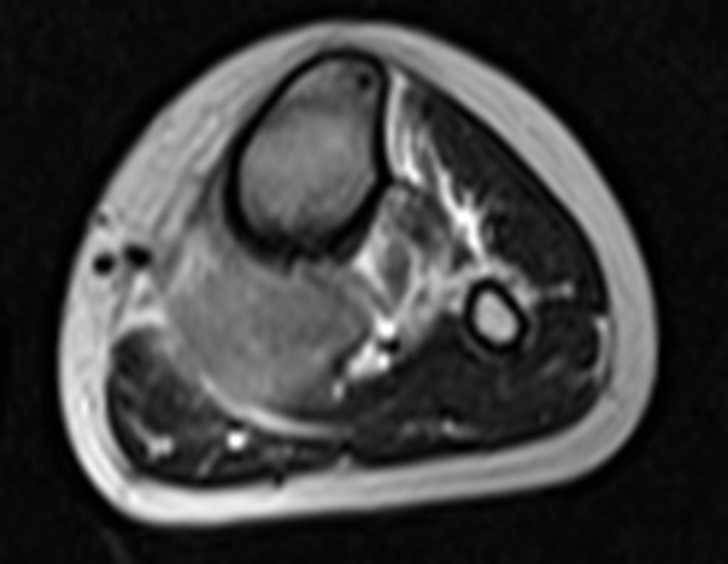 Figura 10: RM axial T2 tse-fil.