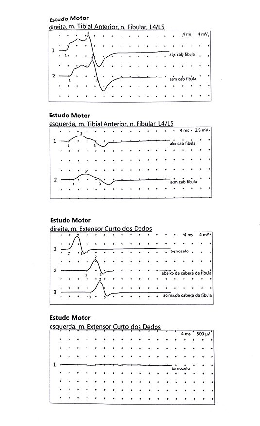 Figura 06: Eletroneuromiografia revelando alteração do nervo fibular do MIE.