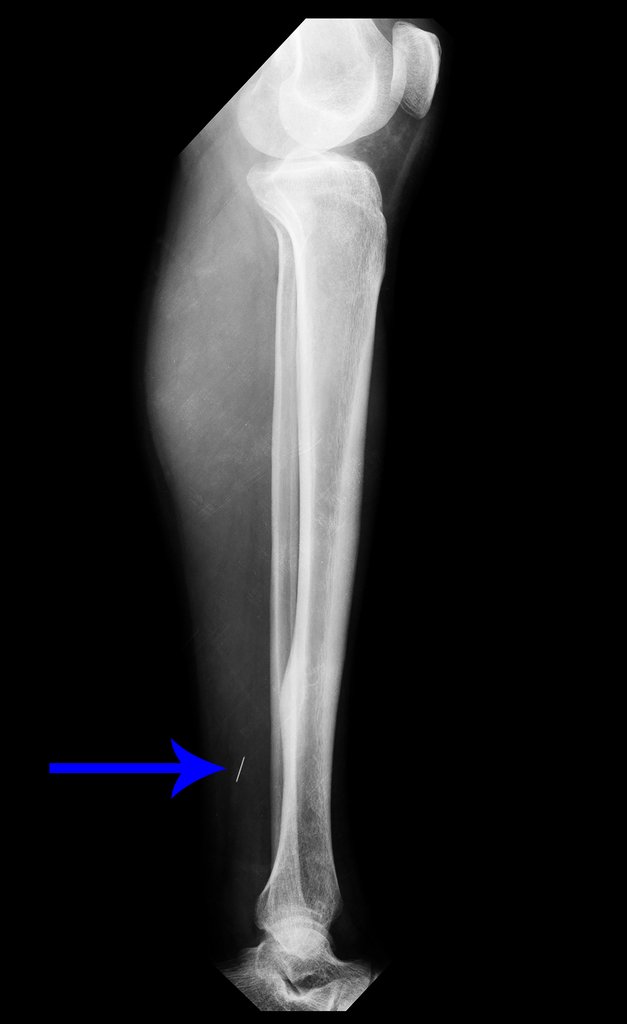 Figura 28: Radiografia perfil da perna, seta azul mostra a imagem nos tecidos moles. Corpo estranho ???