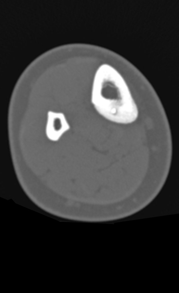 Figura 3: Tomografia axial com esclerose cortical na face póstero medial da tibia.