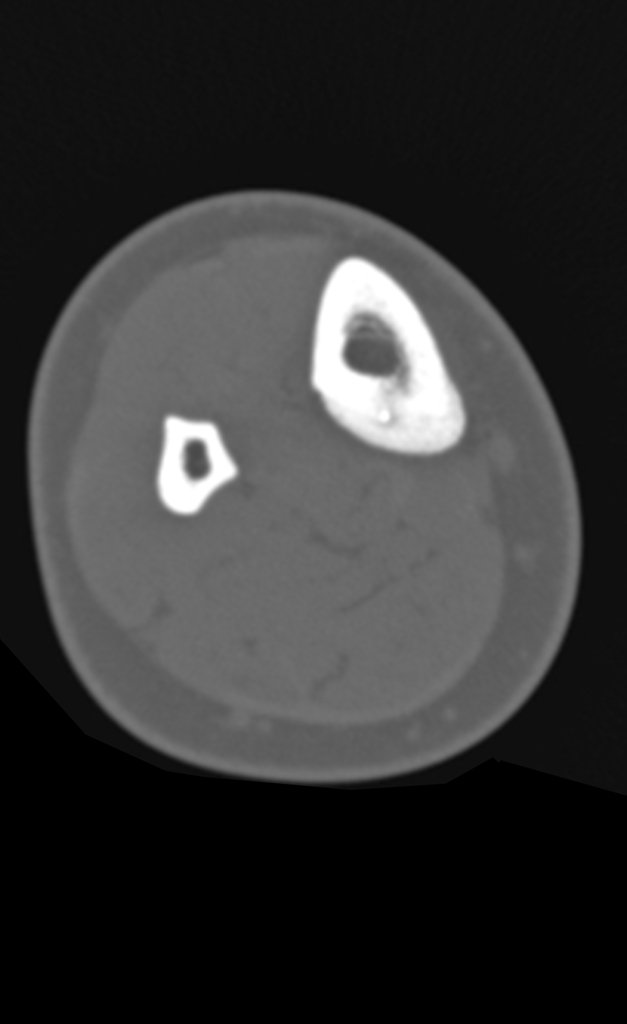 Figura 4: Tomografia axial com evidente nicho central na cortical da face póstero medial da tibia.