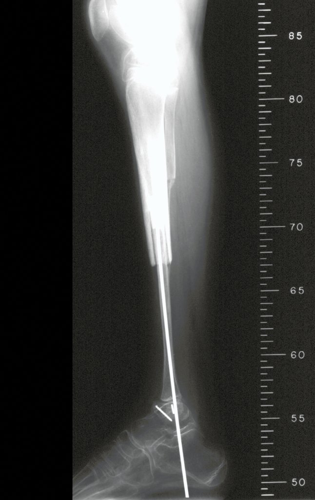 Figura 10 B: Radiografia perfil, em 1998.