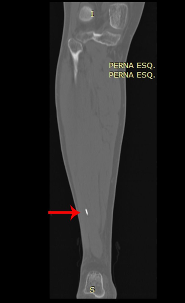 Figura 23: Tomografia coronal com seta em vermelho destacando imagem linear densa no terço distal da perna.