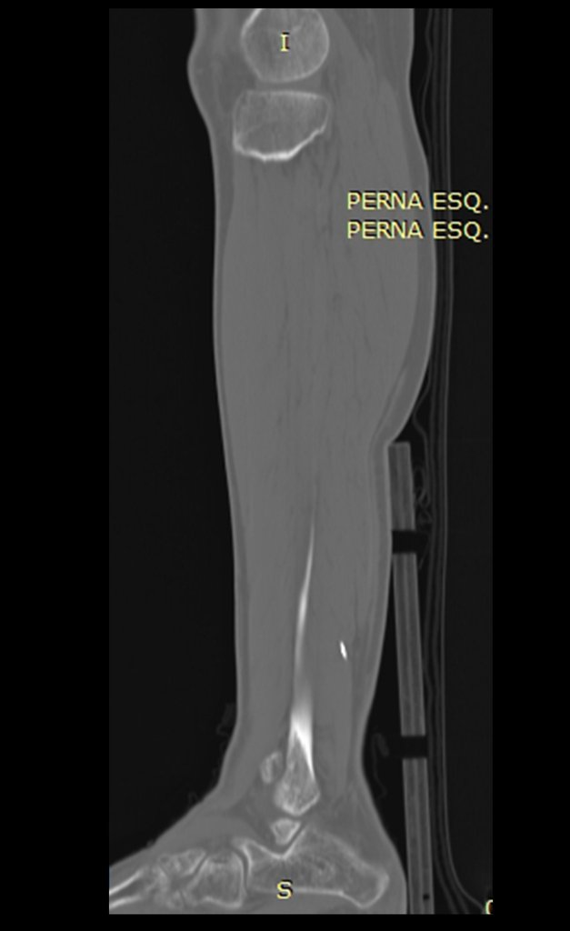 Figura 25: Tomografia sagital com densidade óssea com imagem densa nos tecidos moles da região posterior da perna.