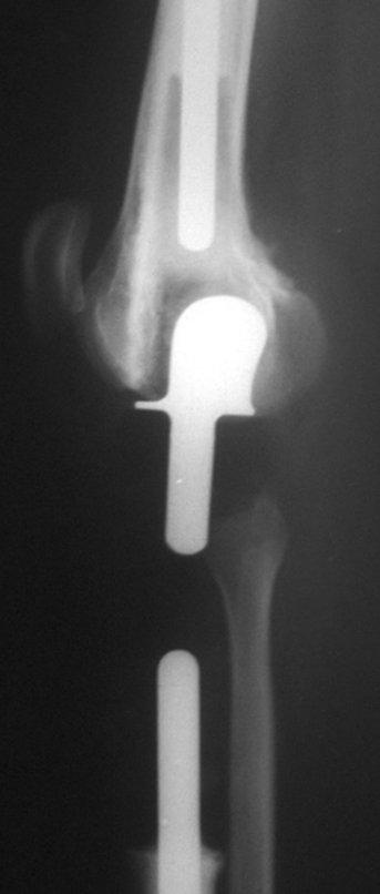 Figura 31: Radiografia, perfil, após um ano e dois meses.