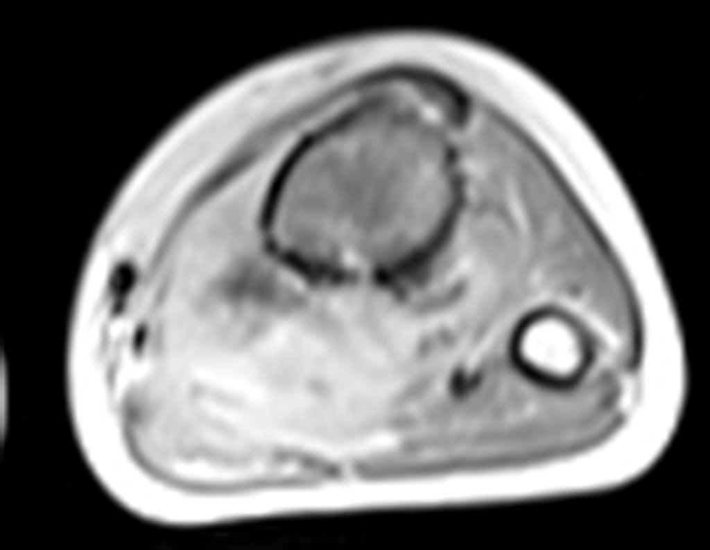 Figura 27: RM axial T1 tse-fil-gad.