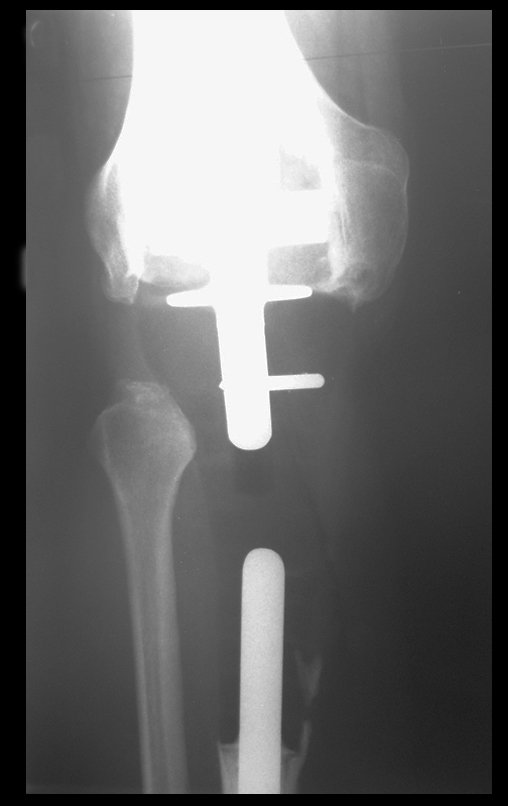 Figura 38: Protrusão do componente femoral, necessitando de revisão, em Abril de 2009, após vinte anos da cirurgia.