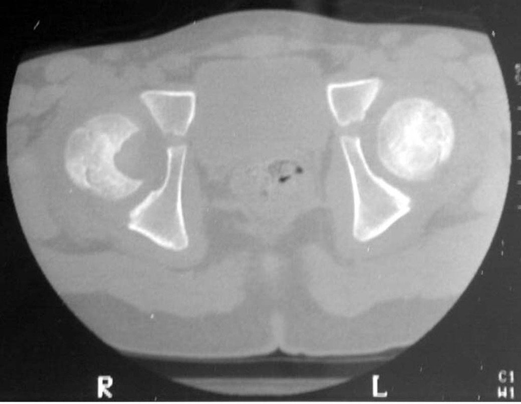 Figura 4: Tomografia do quadril com lesão na cabeça femoral direita, densidade para tecidos moles.