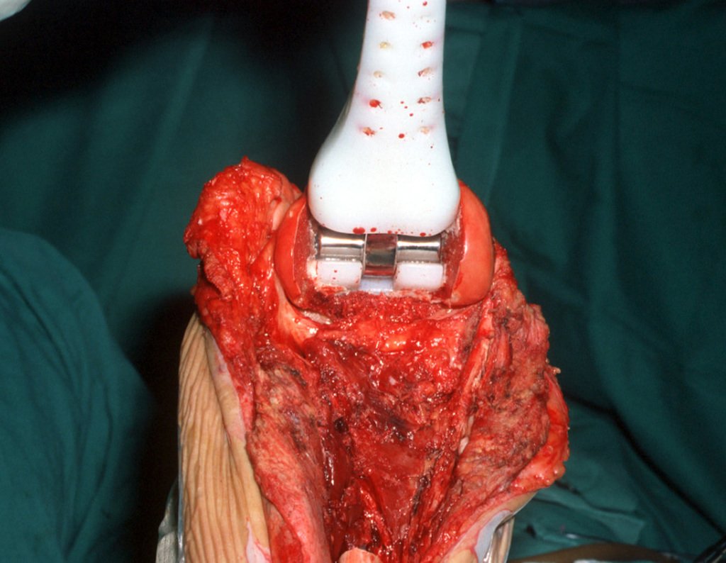 Figura 25: Revisão da hemostasia, antes da cimentação final.