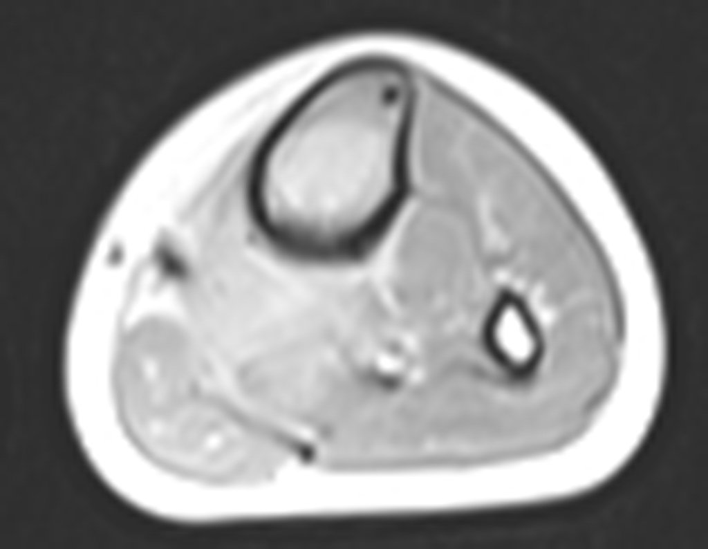 Figura 29: RM axial T1 tse-fil-gad.