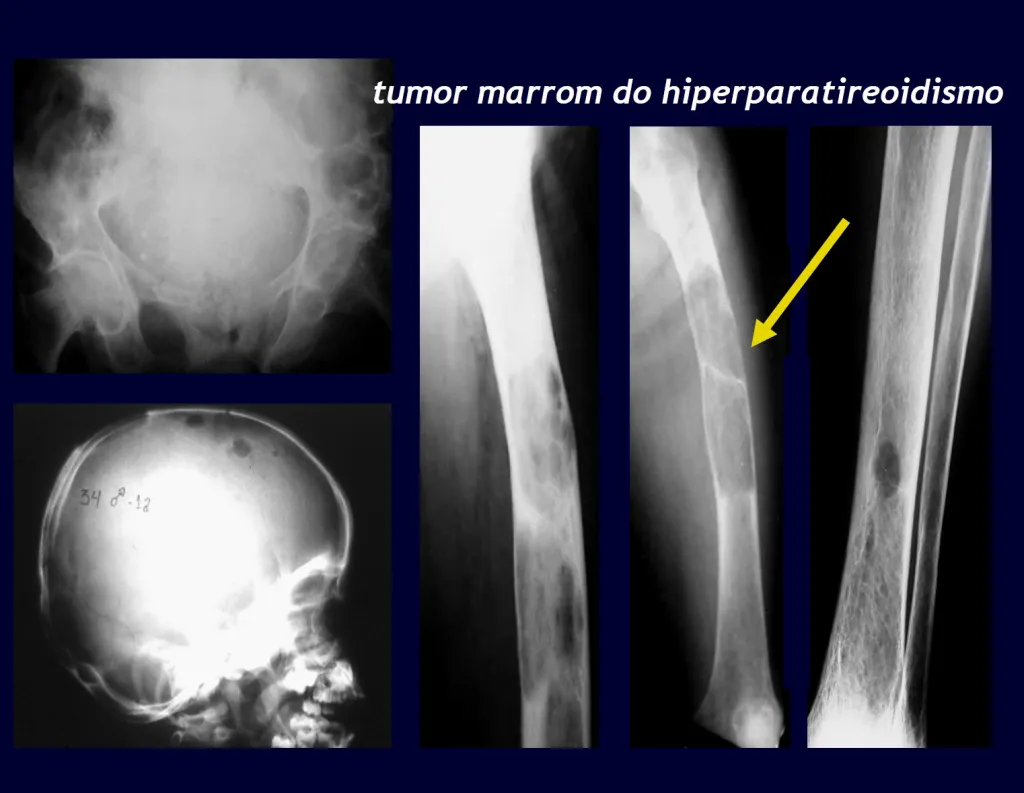 Figura 4 Tumor marron do hiperparatireoidismo