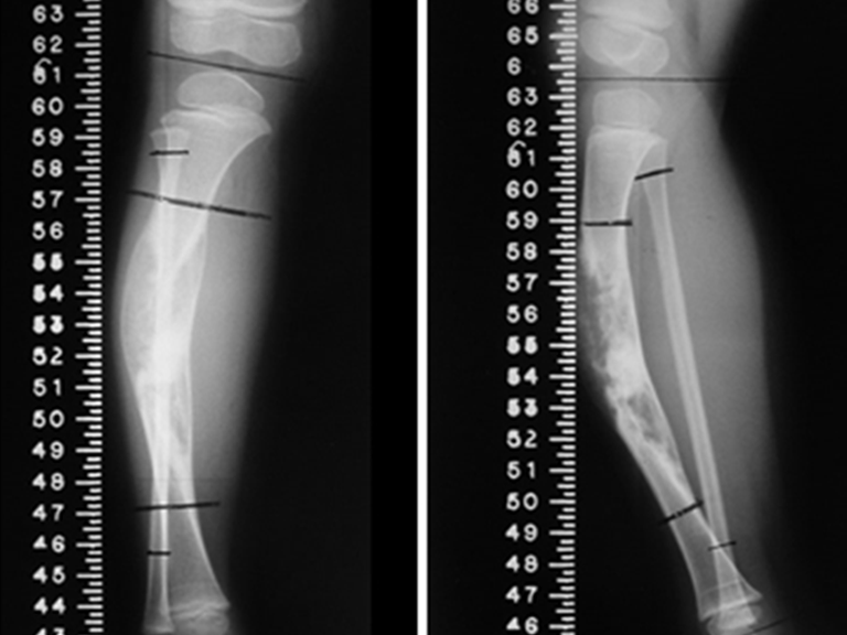 Osteofibrodisplasia - Técnica de Tibialización de la Fíbula