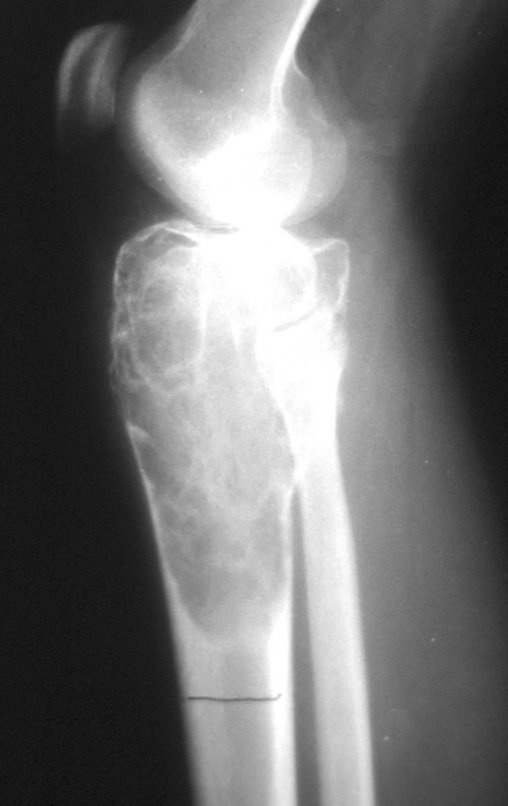 Figura 3: Radiografia, perfil, com lesão na epífise da tibia e diáfise proximal.